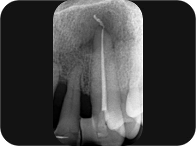 Claudio Farnararo Endodonzia | Endodonzia chirurgica