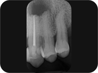 Claudio Farnararo Endodonzia | Endodonzia chirurgica