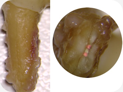 Claudio Farnararo Endodonzia | Caso Trauma