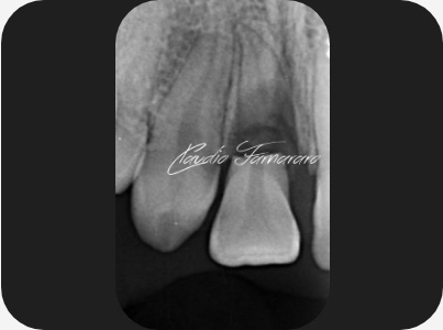 Claudio Farnararo Endodonzia | Caso Trauma