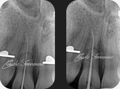 Claudio Farnararo Endodonzia | Caso Trauma