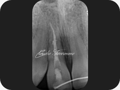 Claudio Farnararo Endodonzia | Caso Trauma